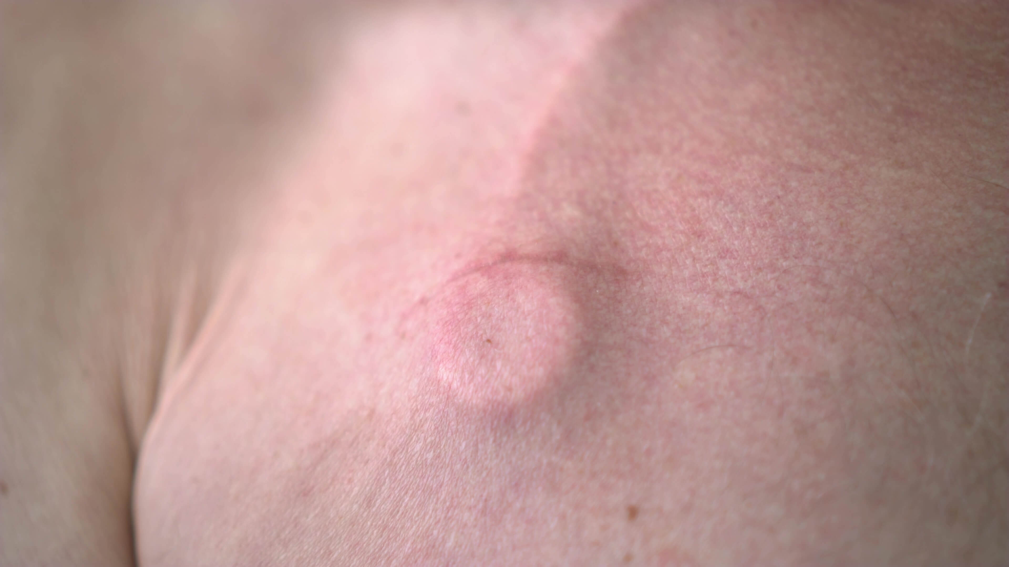 Bard Port Catheter Lawsuits Edgar Snyder & Associates